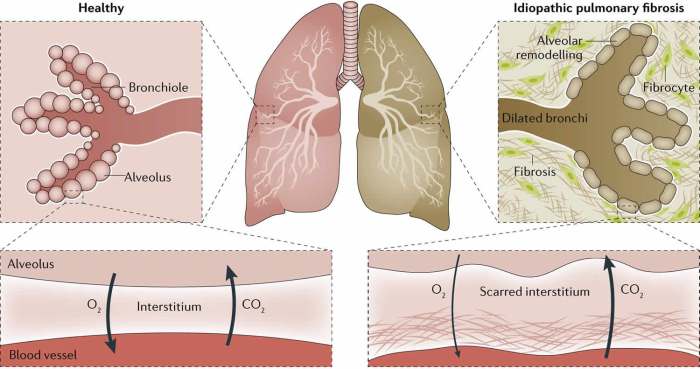 Symptoms clubbing fingers pulmonary fibrosis curved nail fingernail diagnosis downward verywellhealth