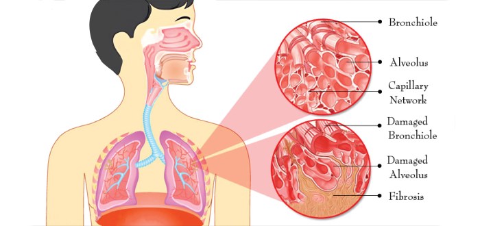 Pulmonary fibrosis symptoms